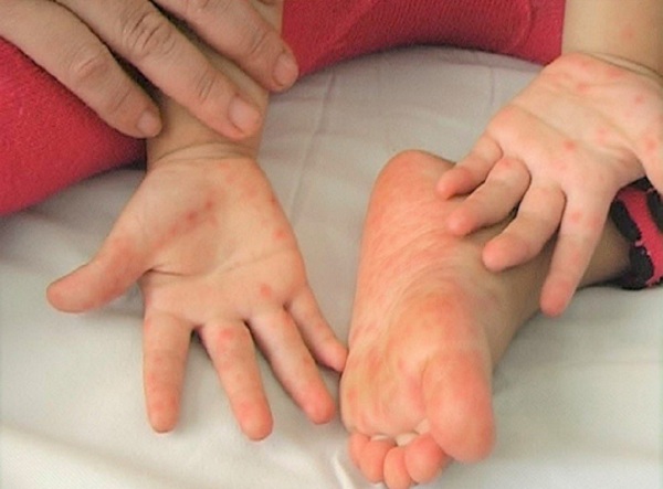 Chăm sóc trẻ mắc tay chân miệng tránh những sai lầm khiến bệnh trở nặng hơn
