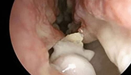 Bác sĩ sốc khi phát hiện răng mọc trong mũi bệnh nhân