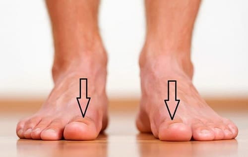 Hãy cẩn trọng nếu bàn chân xuất hiện cùng lúc 3 dấu hiệu này!