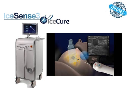 Áp lạnh(cryoablation) bằng máy IceSense phương pháp mới điều trị ung thư vú không phẫu thuật