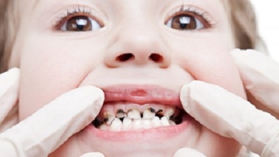 Canada thử nghiệm nhuộm răng đen phòng chống sâu răng