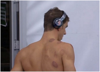 Giải đáp về những vòng tròn đỏ trên người kình ngư Mỹ Michael Phelps