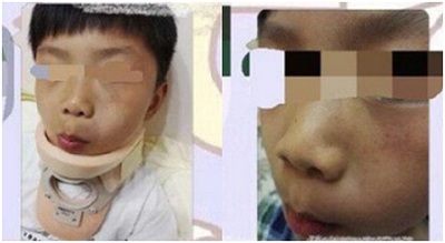 Trung Quốc: Trẻ mầm non bị thoát vị đốt sống cổ vì cô giáo bắt đánh nhau