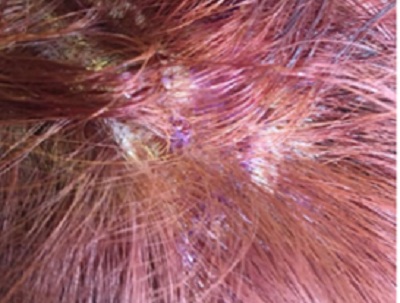 Malaysia: Cô gái bị bỏng da đầu vì nhuộm tóc làm đẹp trước Tết