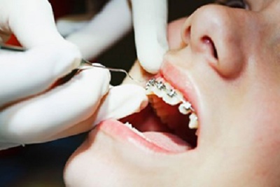 Cô gái Malaysia bị nhiễm trùng răng nghiêm trọng do niềng răng sai cách
