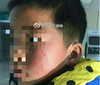 Trung Quốc: Học sinh tiểu học bị hiệu trưởng đâm 17 nhát bút bi vào mặt