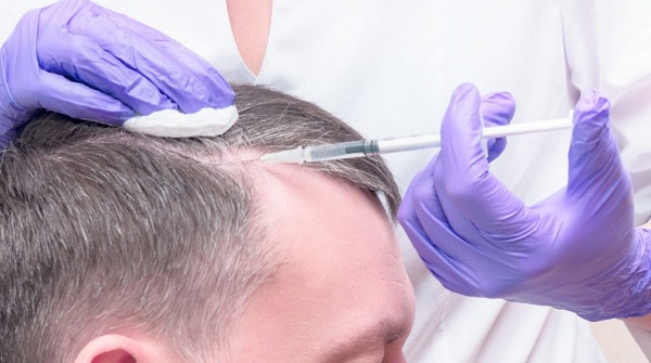 Chăm sóc tóc chuẩn sau khi dùng tế bào gốc tự thân trị rụng tóc