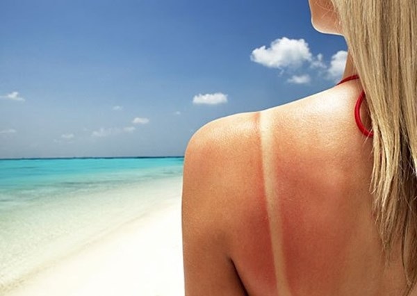 Làn da bị cháy nắng có nguy hiểm không, cách phòng ngừa chuẩn