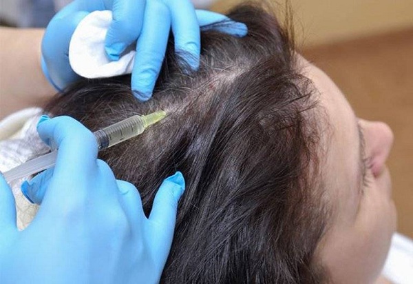 Những tác dụng phụ khi trị rụng tóc bằng tế bào tế bào gốc tự thân