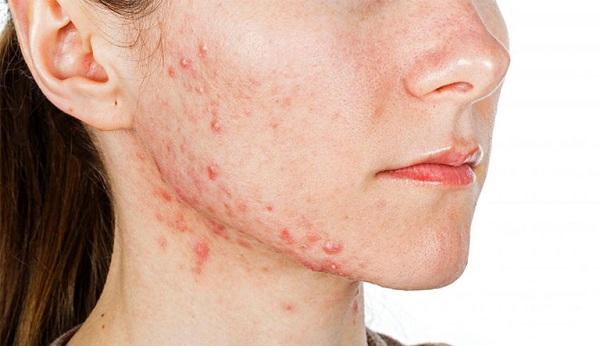 Những tác hại đáng sợ cho da khi dùng mỹ phẩm chứa corticoid