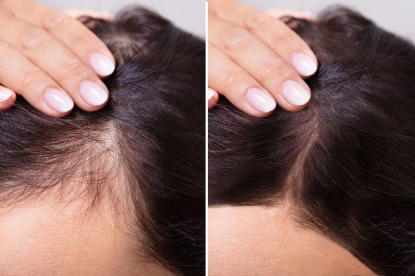 Tế bào gốc trị rụng tóc có ưu nhược điểm gì?