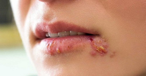 Câu trắc nghiệm Sinh lớp 8 Bài 64 có đáp án: Các bệnh lây truyền qua đường sinh dục (tiếp)