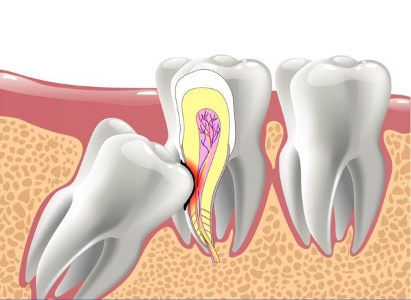 Khi nào nên nhổ răng khôn tránh biến chứng nguy hiểm?
