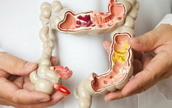 Mối liên hệ vi khuẩn đường ruột và bệnh crohn như thế nào?