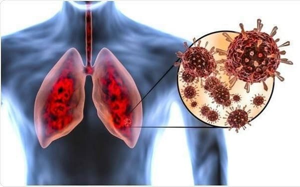Nghiên cứu mới nhất: Covid-19 ảnh hưởng đến phổi như thế nào 