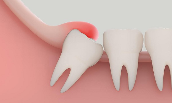 Nhổ răng khôn: những rủi ro nguy hiểm có thể xảy ra