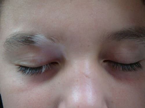 Những dấu hiệu thay đổi trên lông mày cho thấy sức khỏe đang có vấn đề