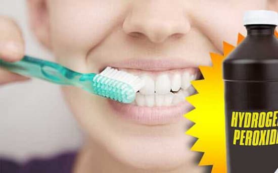 Tẩy trắng răng bằng hydrogen peroxide liệu có an toàn?